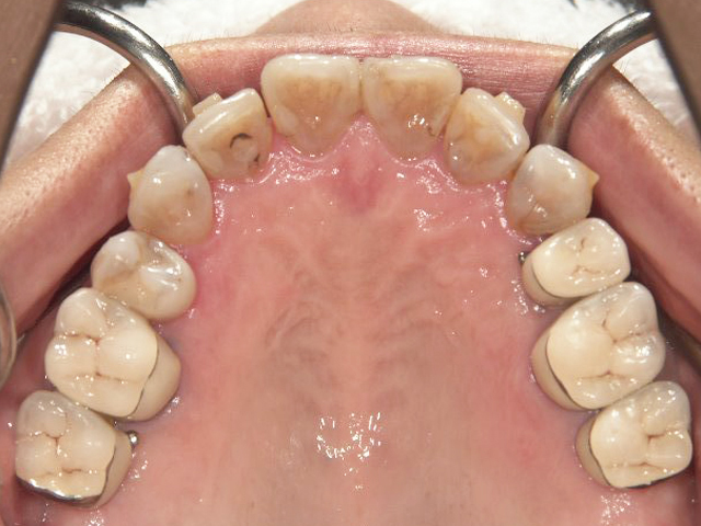 前歯部クロスバイト