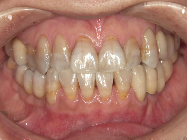 前歯部クロスバイト